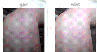 肥胖紋
