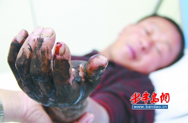 鄒先生的左手被蛇咬傷后明顯腫脹。