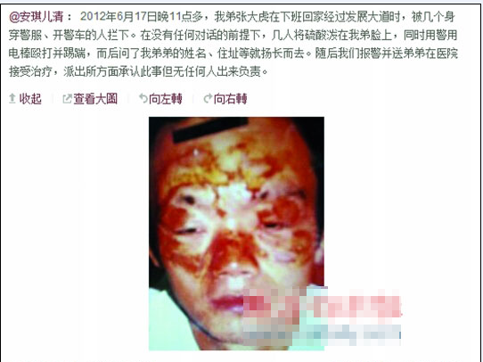 張大虎的姐姐將弟弟面部燒傷一事發(fā)上微博，引發(fā)網(wǎng)友廣泛關(guān)注。